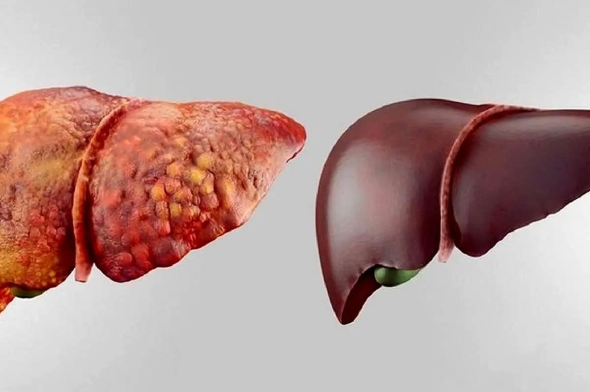 علائم خاموش کبد چرب و راهکارهای موثر برای بهبود آن