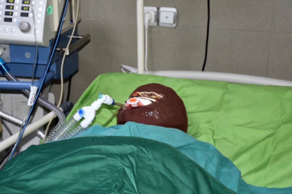 اسیدپاشی وحشیانه مرد جوان در چشمان خواهرش؛ دست و پاهایم را بست و...