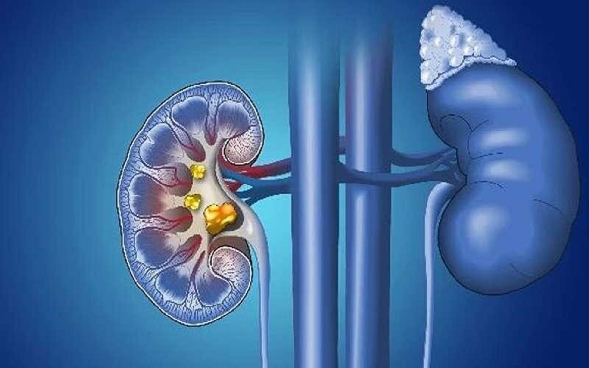 روش خانگی دفع سنگ کلیه بدون دارو