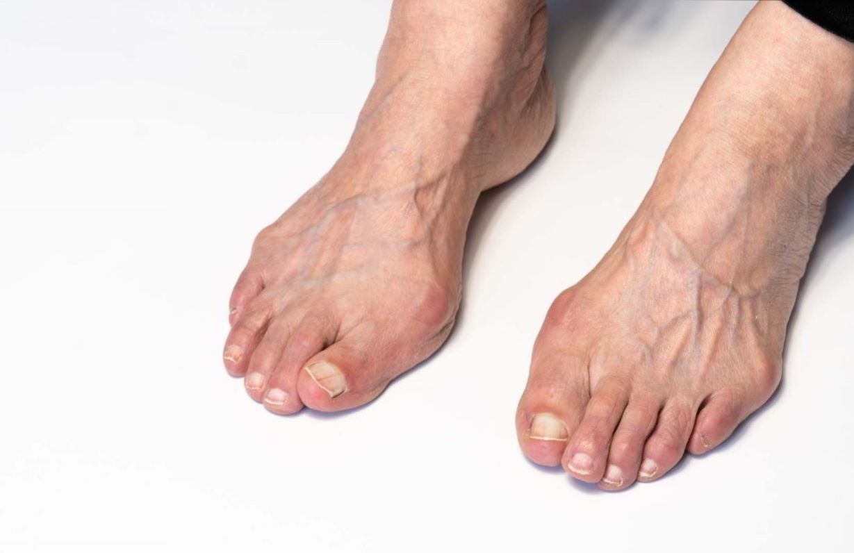 چگونه انگشتان خم شده پا را اصلاح کنیم؟؛ علائم انگشت چکشی پا