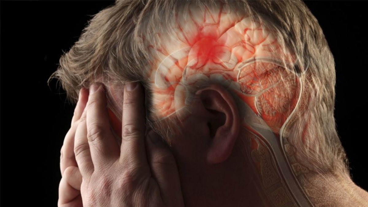 ۴ ساعت طلایی برای نجات جان بیماران سکته مغزی