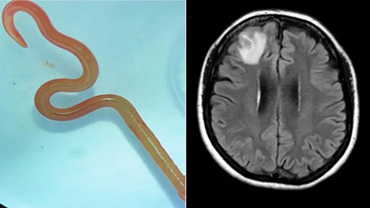 خارج کردن کرم ۱۸ سانتی‌متری از مغز یک مرد+ عکس