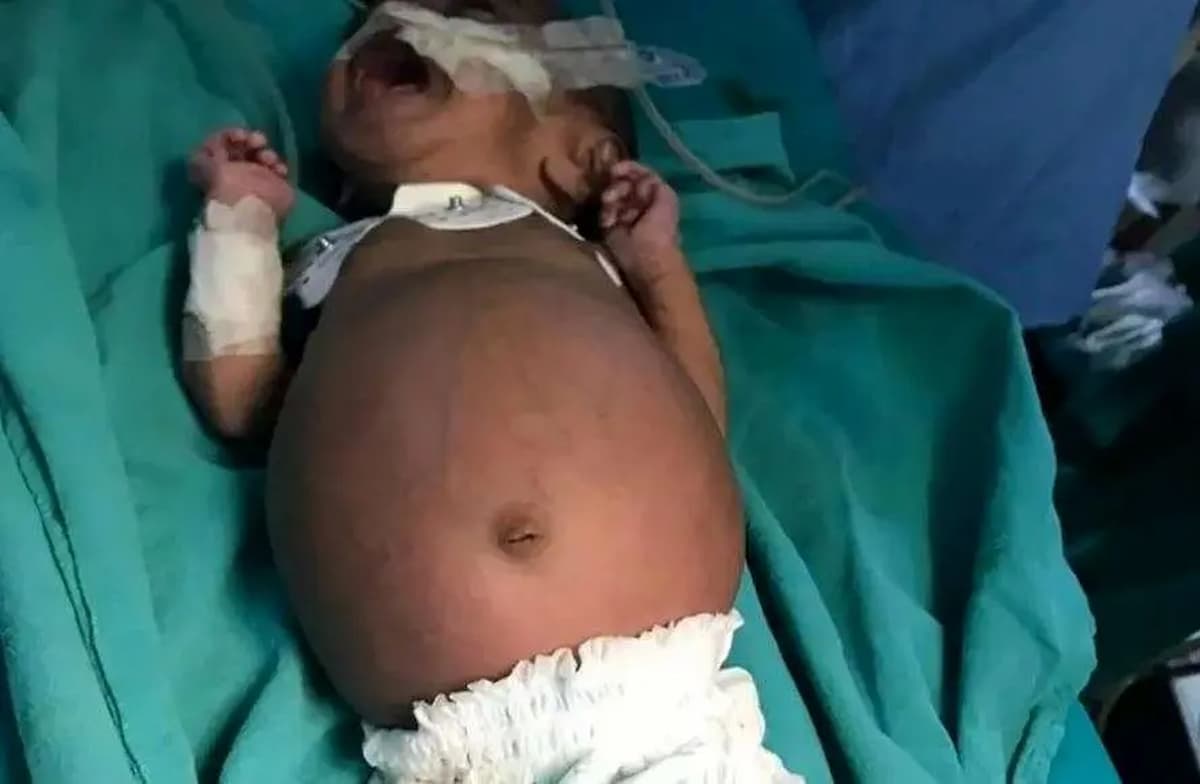 اتفاقی نادر؛ تولد نوزادی که جنین دوقلوی خود را قورت داده بود+عکس