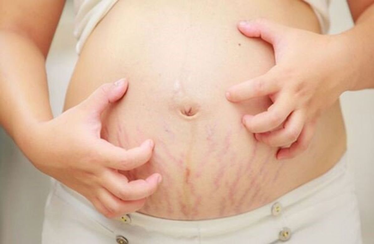 درمان ترک شکم بعد زایمان با روشهای خانگی و تخصصی