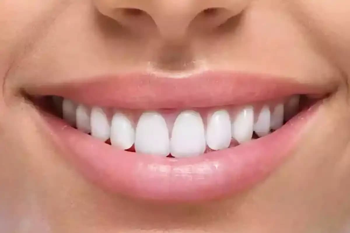 چه کسانی نباید سراغ لمینت و کامپوزیت دندان بروند؟