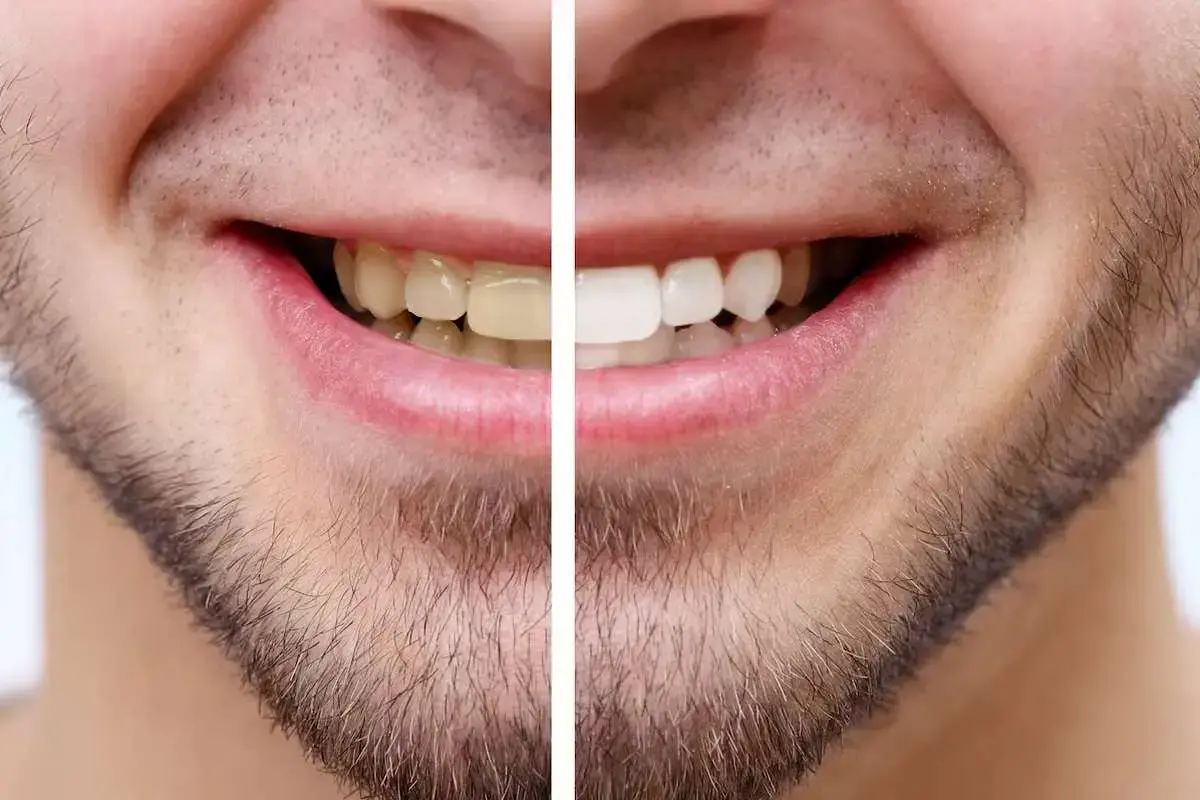 ویتامین‌های لازم برای دندان‌های براق؛ از تقویت مینای دندان تا جلوگیری از پوسیدگی